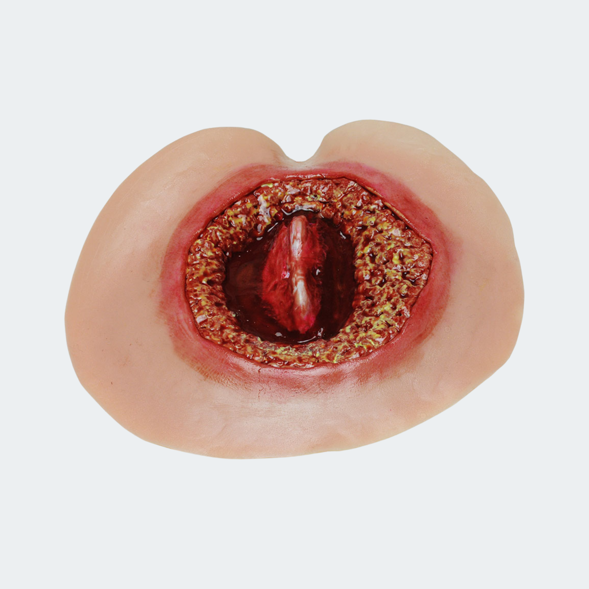 4th Stage Bed Sore