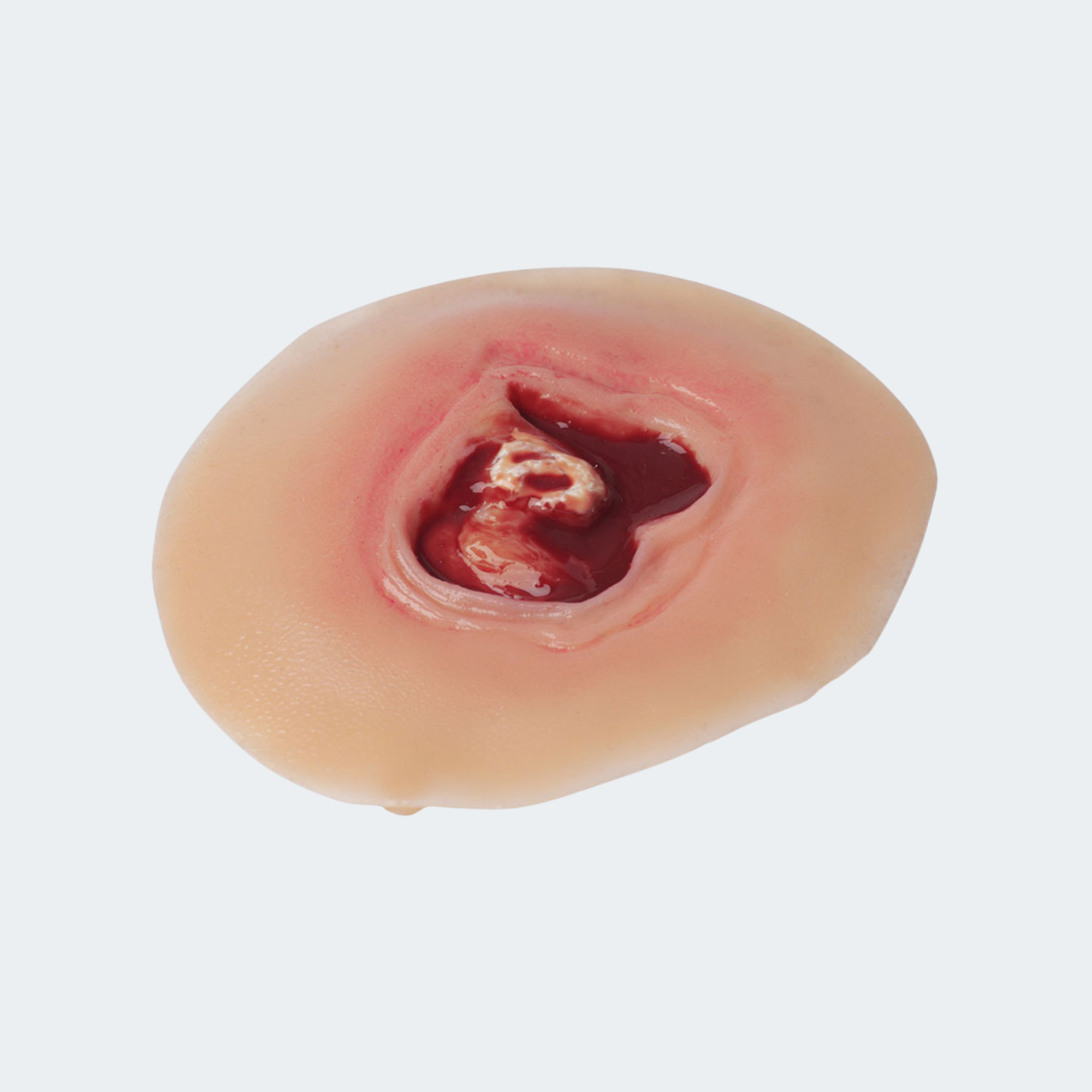 Diabetic Ulcer - 20mm