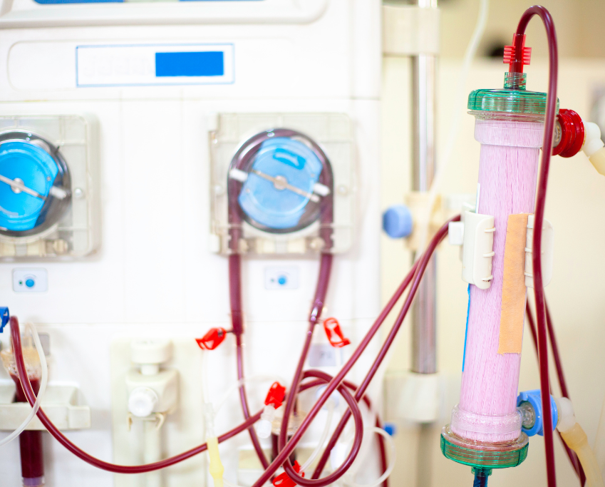 Hemodialysis machine with blood lines and dialyzer, for kidney dialysis treatment.