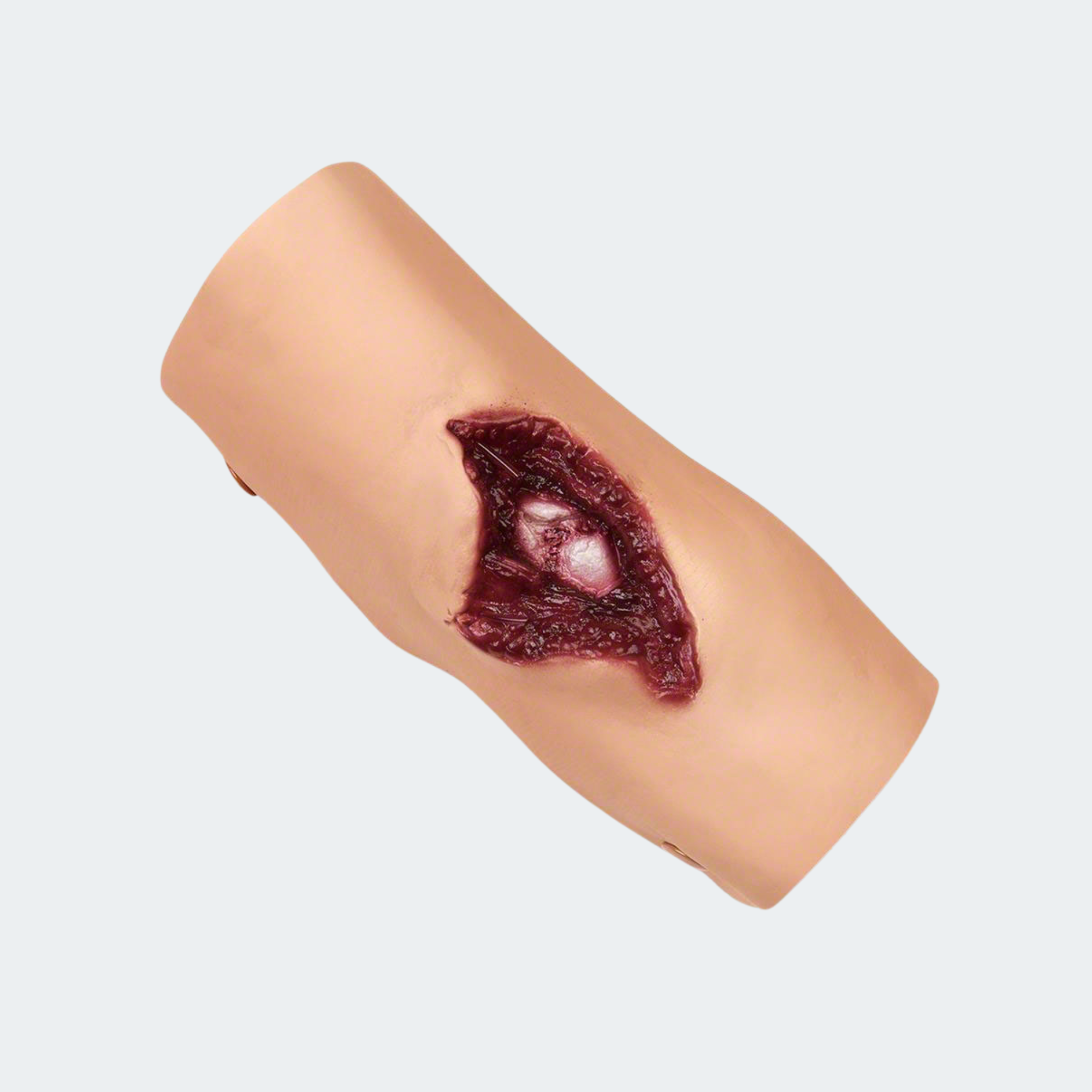 Simulaids Compound Fracture Humerus/Upper Arm
